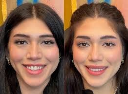 lip flip before and after